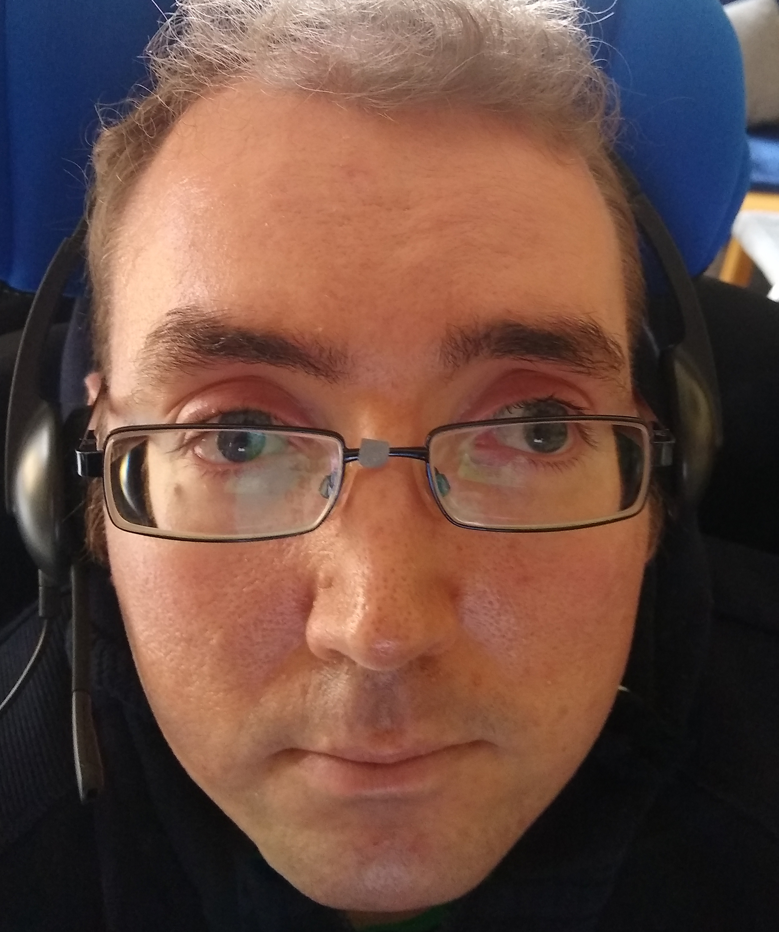 A close-up of a man's face wearing glasses and with the left eye pointing outwards and the right eye centred